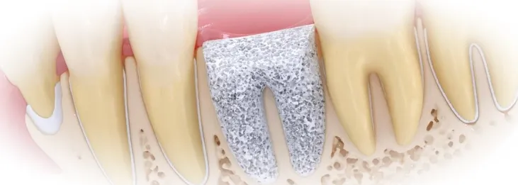 Синус-лифтинг перед имплантацией зубов