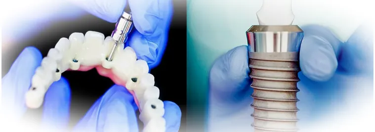 Этапы имплантации