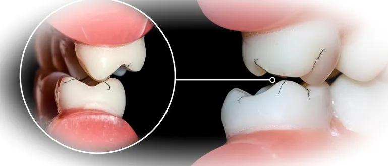 Бруксизм: причины и лечение скрежета зубами