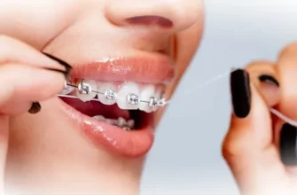 Гигиена полости рта во время ношения брекетов