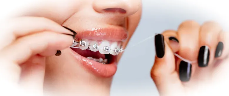 Гигиена полости рта во время ношения брекетов