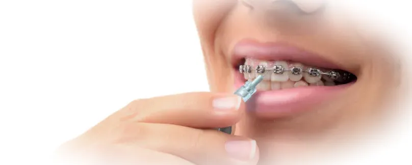 Основные правила ухода за брекетами