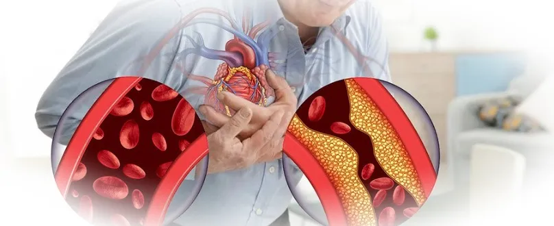 Опасный враг — ишемическая болезнь сердца и её симптомы