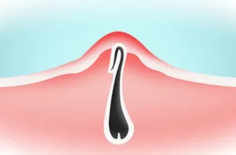 Почему появляются вросшие волосы в зоне бикини и как избежать неприятных последствий?