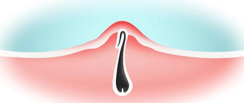 Почему появляются вросшие волосы в зоне бикини и как избежать неприятных последствий?