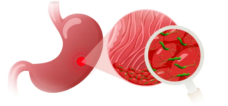 Основные причины гастрита