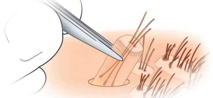 пересадка волос и бороды