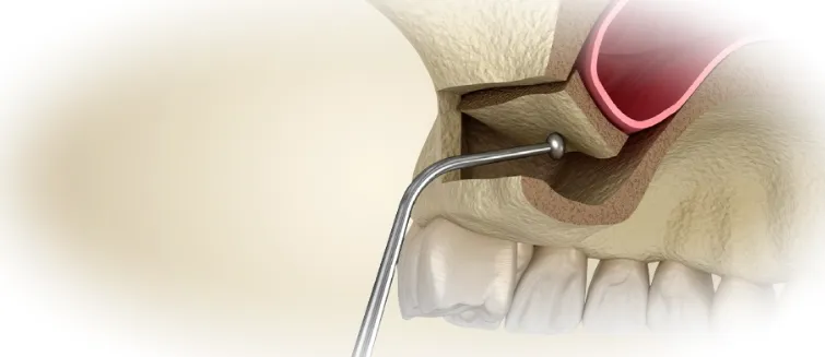 синус лифтинг