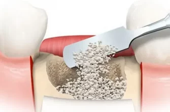 Современные методы костной пластики в стоматологии