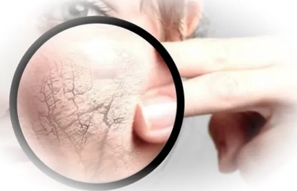 Как уменьшить чувствительность кожи зимой