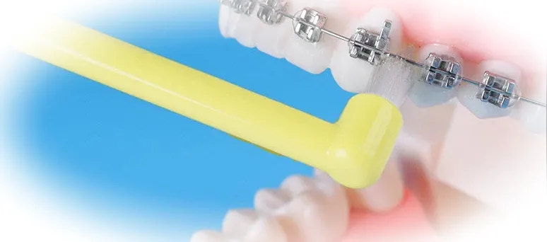 Применение монопучковых зубных щеток