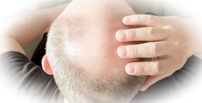 Причины усиления выпадения волос