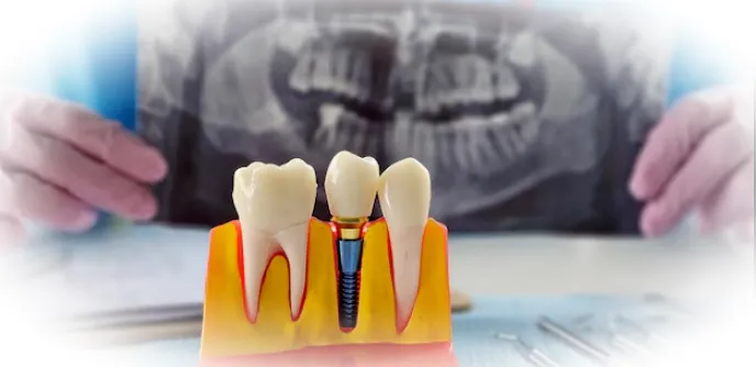 Как проходит процедура имплантации?