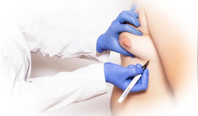 Способы исправления гинекомастии у мужчин