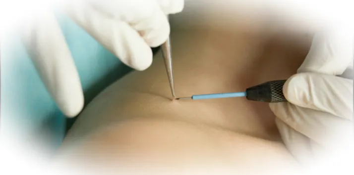 Как проходит процедура удаления родинки