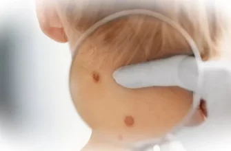 Удаление родинок у детей: когда это необходимо и как проходит процедура? Советы родителям