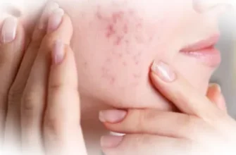 Угри и воспаления кожи: почему возникают и как лечатся?