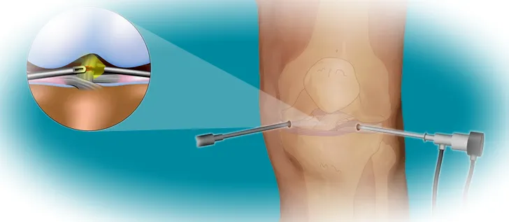 Виды операций на мениск