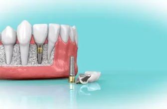 Зубные имплантаты — надёжная альтернатива протезированию