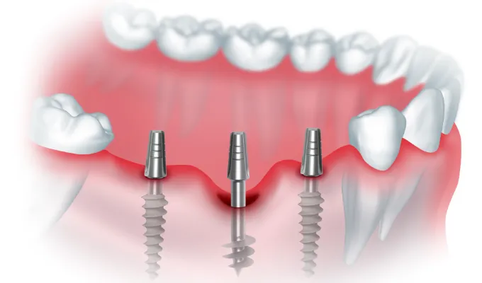 Подготовка к операции и фиксация протеза