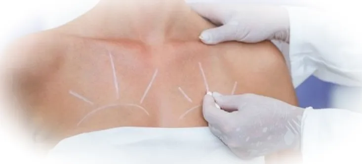 Техники редукционной маммопластики 