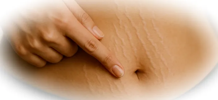 Чтобы минимизировать риск появления стрий