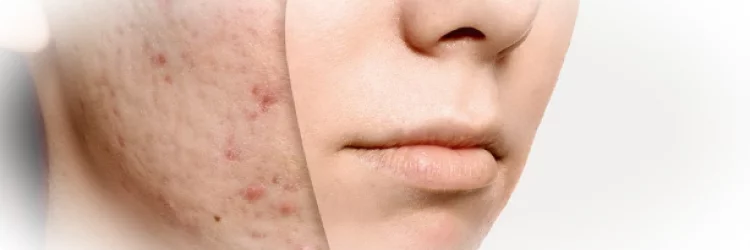 Как удалить шрамы от прыщей