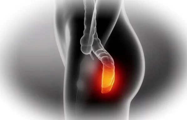 Как лечить геморрой