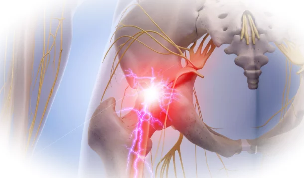 Что такое ишиас, каковы его причины и как его лечить?