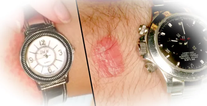 Признаки непереносимости металла